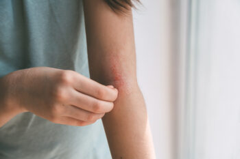 dermatitis